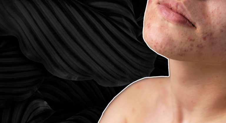 Do Cold Showers Help Acne? (ANSWER)